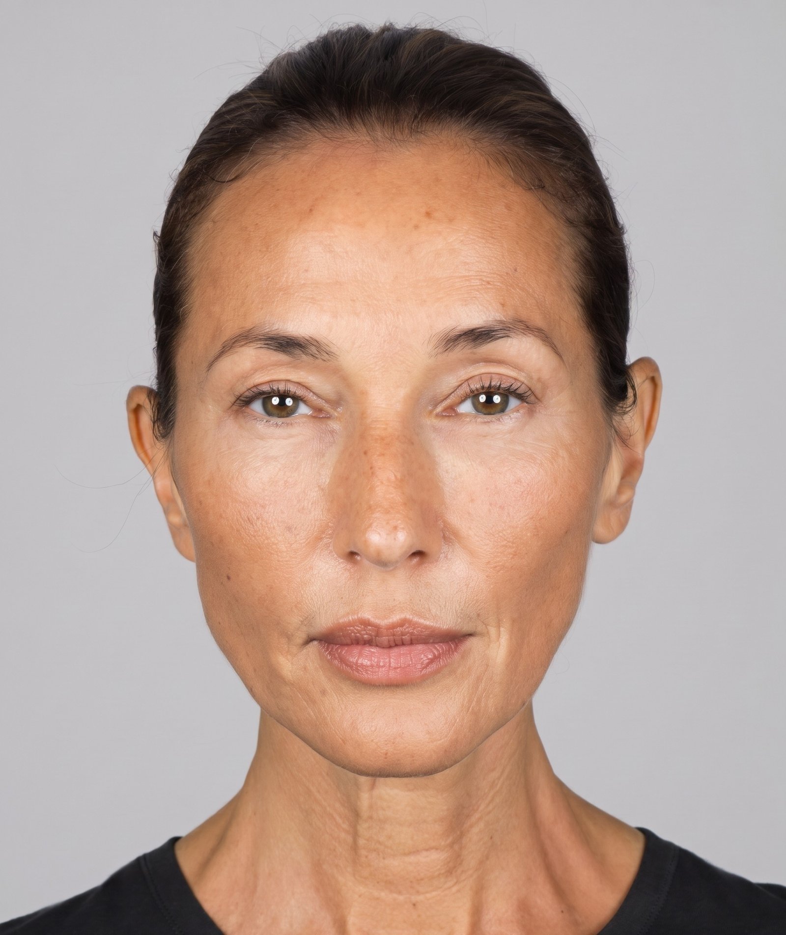 Rejuvenecimiento facial con efecto lifting mediante lipofilling en Madrid