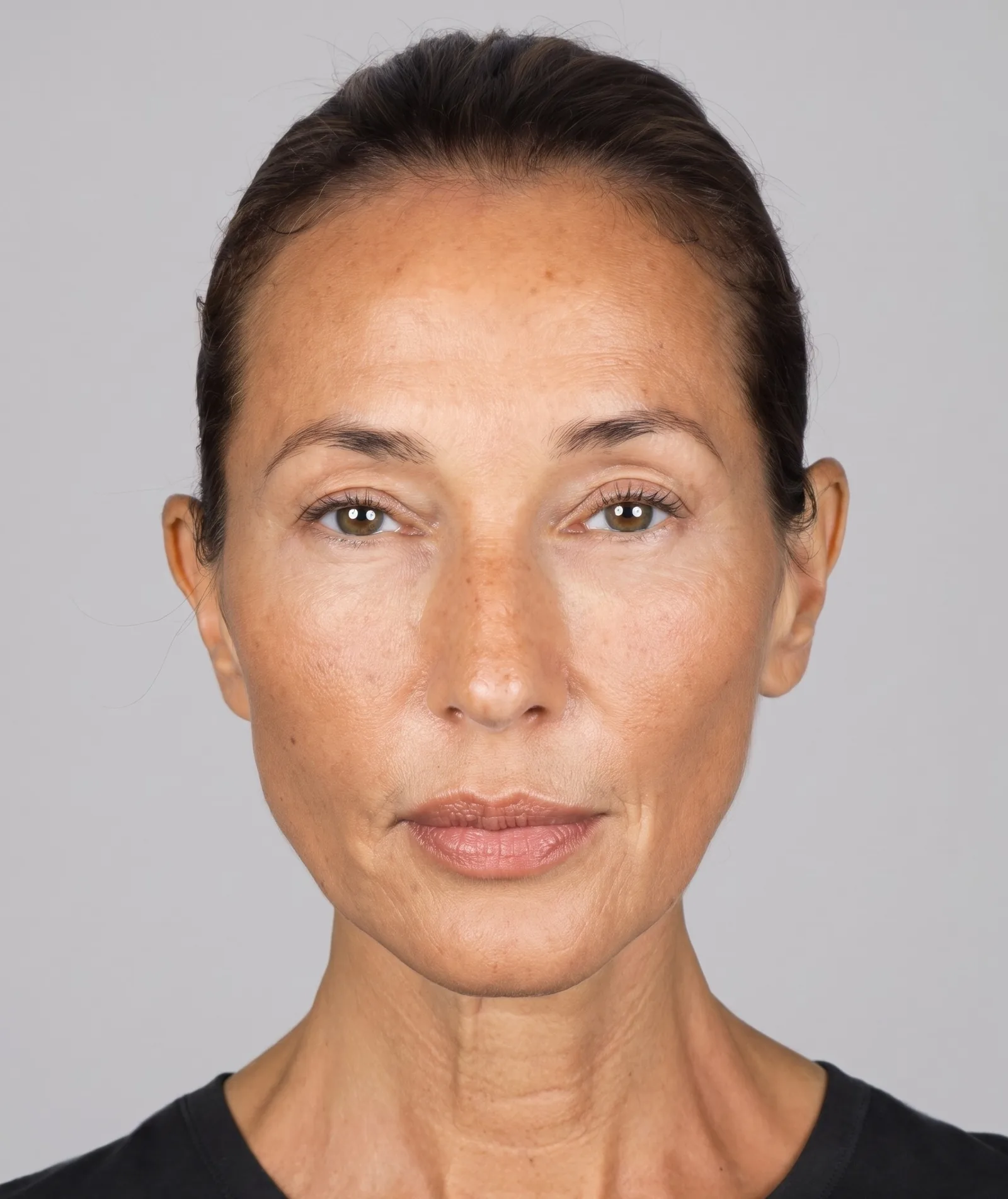 Rejuvenecimiento facial con efecto lifting mediante lipofilling en Madrid